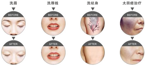 Protable 1064nm / 532nm ND YAG Laser Tattoo Removal Machine For Salon