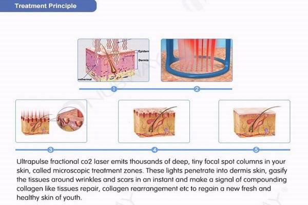 RF Fractional co2 laser acne scars removal and vaginal tightening machine