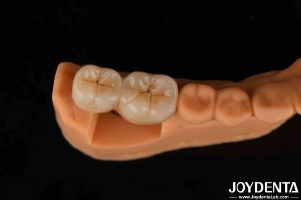 V Shaped Thread Type Finished Abutments Compatibility With All Major Implant Systems