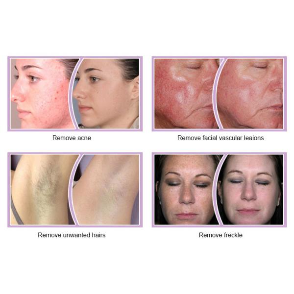 New Style Painless IPL Home Hair Removal Machines Portable Pigment Removal