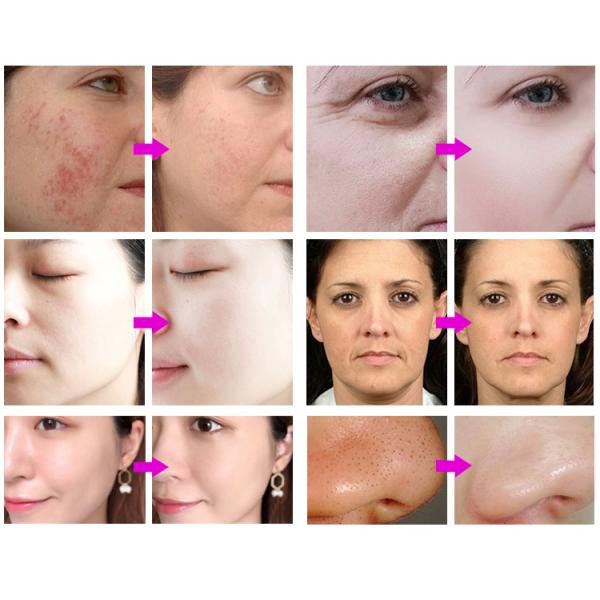 Aesthetic Oxygen Jet Aqua Peel Facial 7 in 1 Hydro Micro Dermabrasion Oxigen Hydra Microdermabrasion Beauty Machine
