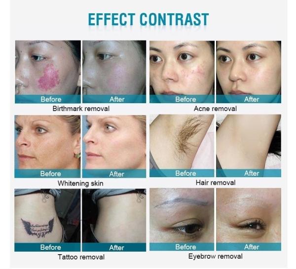 Gomecy Carbon Laser Peeling Machine Branqueamento Facial Máquina de Laser Ndyag Para Cuidados de Beleza