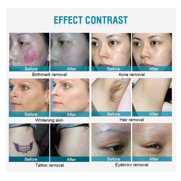 1064nm 532nm 1320nm Q Switch Nd YAG Лазерная машина для удаления татуировок с карбоновым пилингом