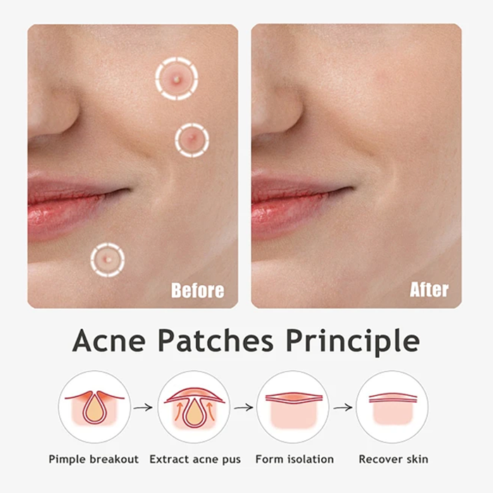 Premium Hydrocolloid Acne Patches – Effective, Non-Irritating  Reduces Redness, Protects Pimples