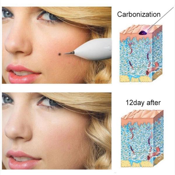 Home LCD Screen Cosmetic Devices Plasma Pen Beauty For Tattoo Removal