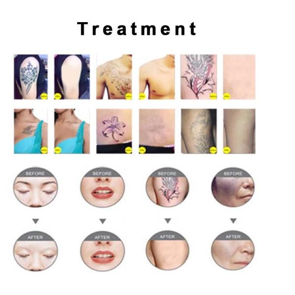 Q - Switched Nd Yag Laser Machine , Portable 1064 / 532nm Laser Tattoo Removal Equipment