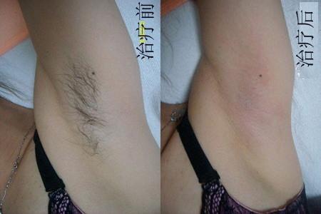 Medical CE Function IPL hair removal IPL Beauty laser machine