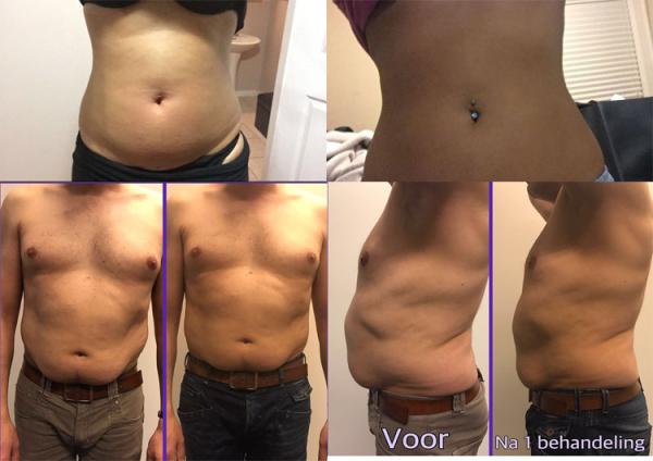 Germany CE approved 5 head safe cool body slimming  freeze fat kryolipolyse