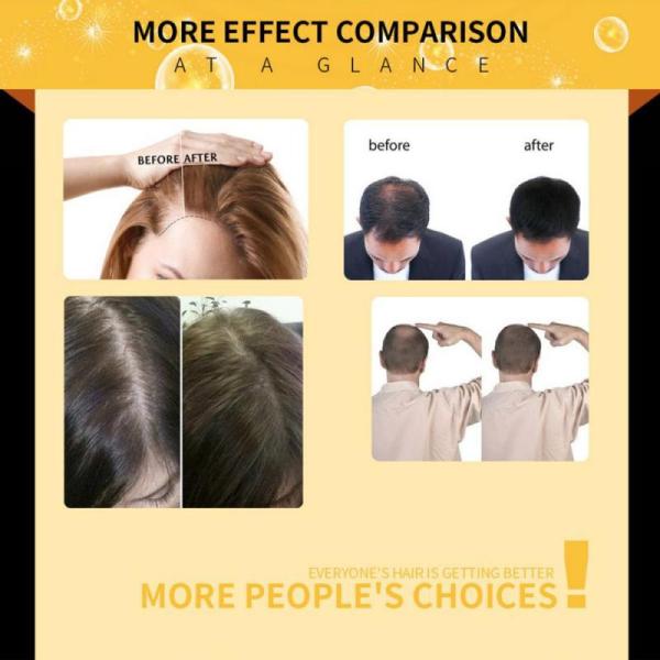 Anti Ginger 1ml / Times Hair Regrowth Serum Anti Loss Treatment Liquid