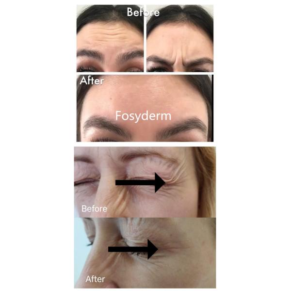 Jeringuilla cutánea del ácido hialurónico de la inyección 2ml del llenador del cuidado personal de la cara de Fosyderm