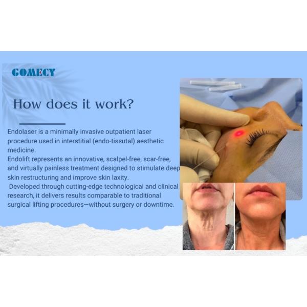 980 1470nm Dual Laser Device for Minimally Invasive Face Lift and Varicose Vein Care