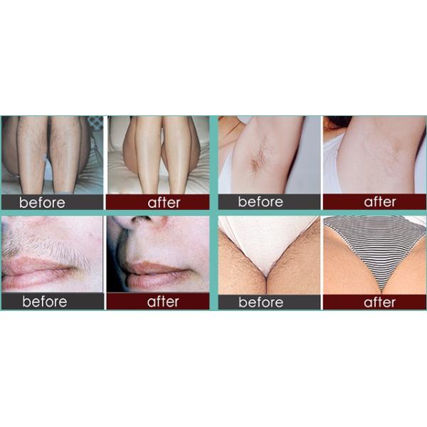Easy Operation 808nm Diode Laser For Hair Removal 8 Inch DWIN Touch Screen