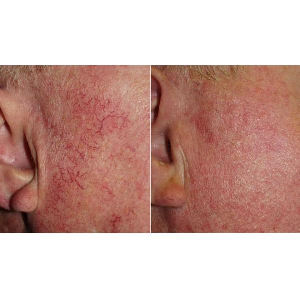 30MHZ with 150w power painless skin tags removal machine pupular in medical clinic