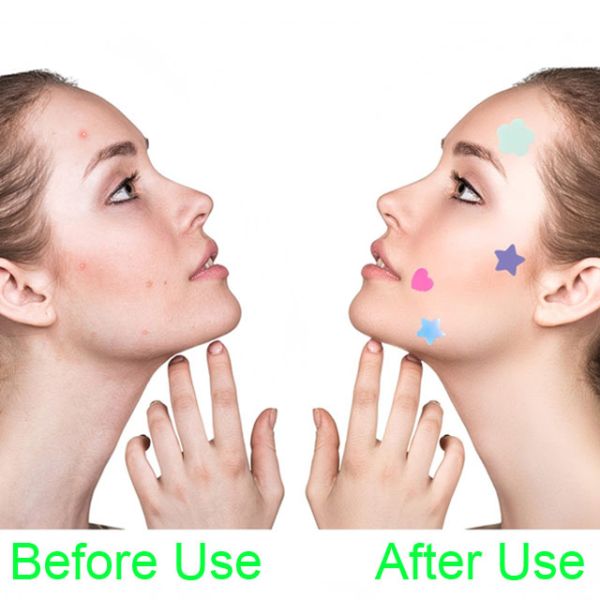 Lovely Flower Hydrocolloid Acne Sticker For Acne Recovery Treatment Custom Color