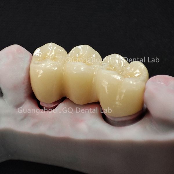 Implant Teeth Zirconia Ceramic Crown Dental Bridge 3D Laser Printing Customized