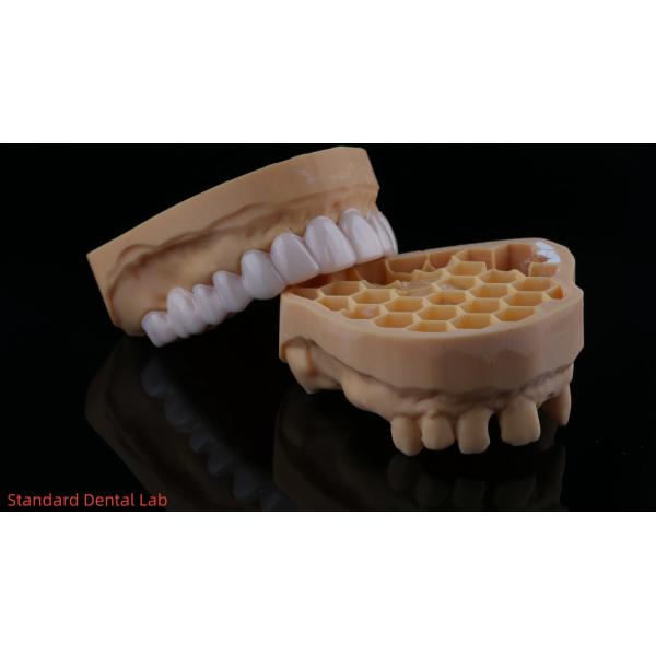 High Esthetics Dental Snap On Smile Standard Dental Lab Removable Dental Appliance