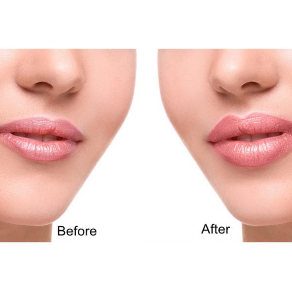 Заполнитель губ вводимого дермального заполнителя Skinject кисловочный Hyaluronic