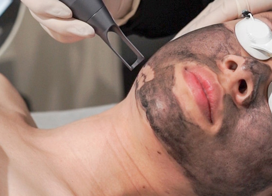 Pigments Freckle Removal Q Switch Yag Laser Machine / Nd Yag Laser System