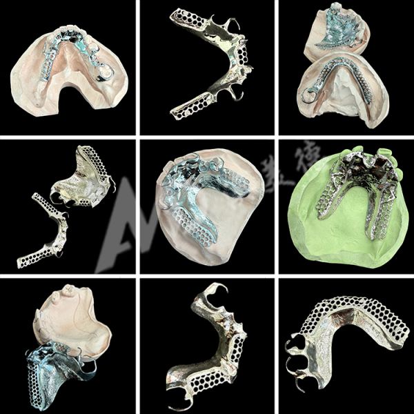 Custom Metal Framework Partial Denture with Invisible Clasps for Precision Fit and Superior Esthetics