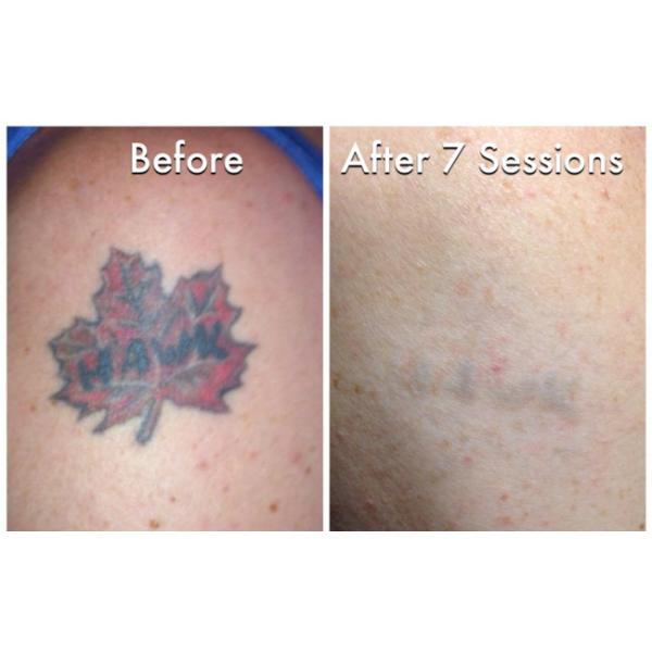 Picosure Laser Clinic Tattoo Removal 755 Nm Q Switched Pigmentation Removal Machine