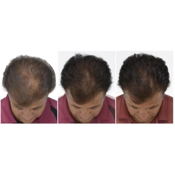 Польза салона выпадения волос скальпа машины красоты Pdt терапией кислорода анти-