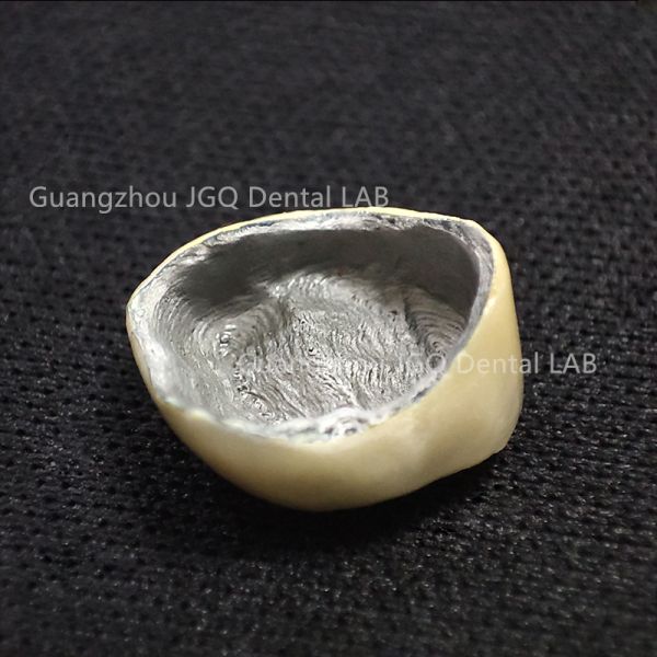 China Dental Lab Full Metal Pfm Crowns and Bridges 3D Digital for Dental Clinics
