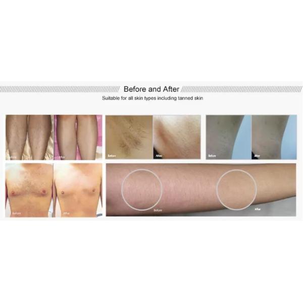 оборудование удаления волос диода результата 810нм профессиональной машины ипл хорошее