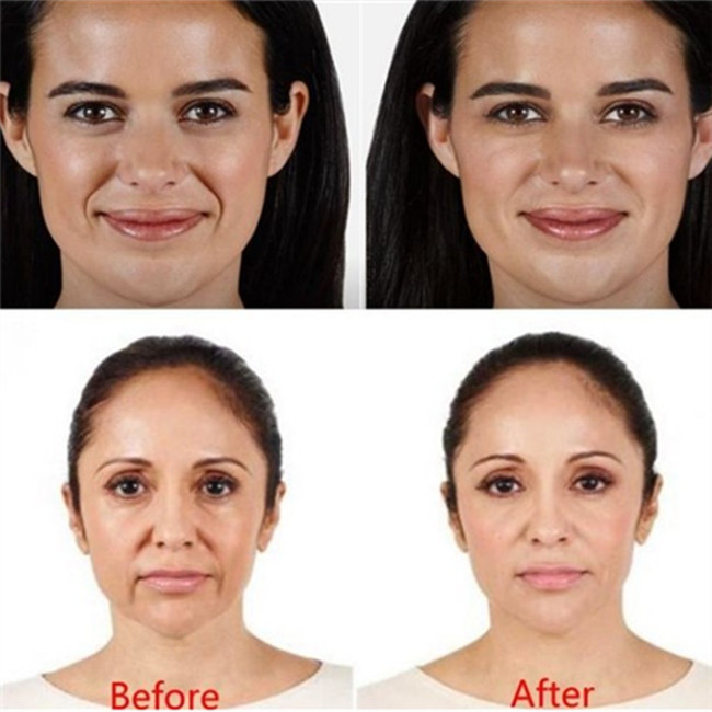 Заполнитель груди ультра 4 Juvederm Hyaluronic кисловочный вводимый