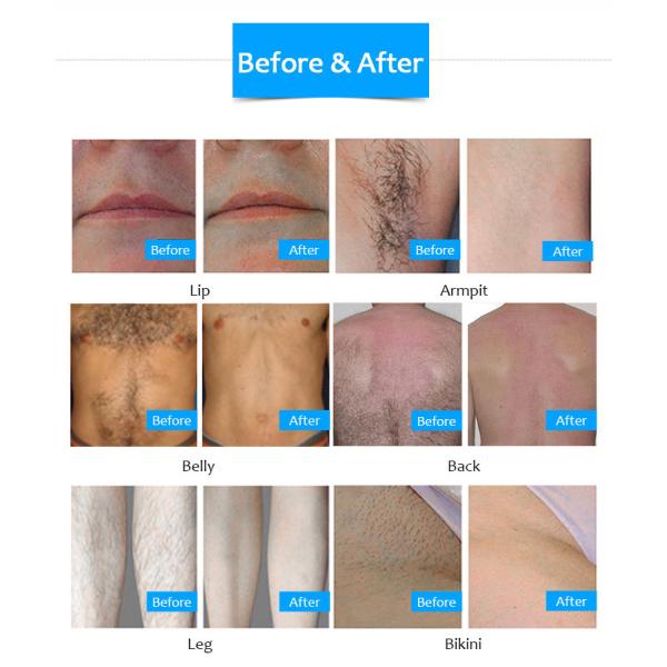 Vertical Ipl Wavelength 640nm Opt Hair Removal Machine