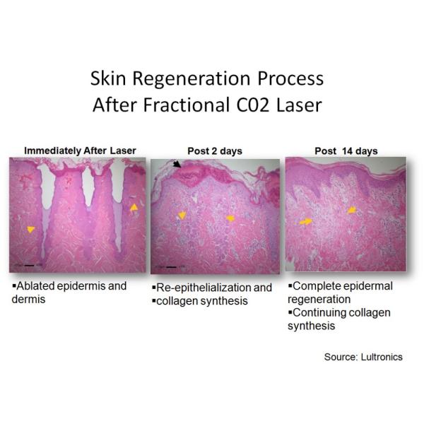 Частичный лазер СО2 применяет обложку к удалению шрама угорь удаления морщинки подмолаживания для красоты