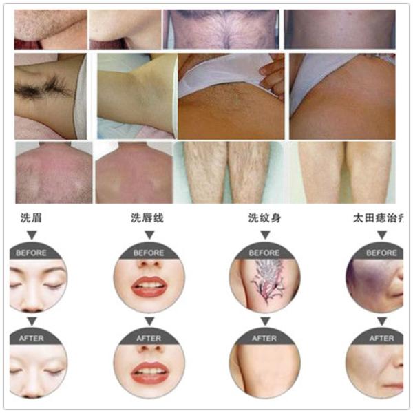 Clinic Skin Treatment E- Light IPL RF Leg Hair Removal yal laser Machine