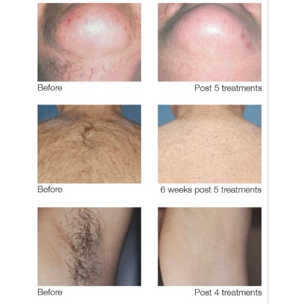 Máquina de depilación por láser de diodo portátil de alta potencia 755nm 808nm 1064nm 3 longitud de onda