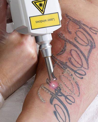 tattoo removal laser tattoo removal Q Switch Nd Yag Laser Tattoo Removal System 1064 Nm 532nm Nd Yag Laser