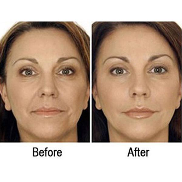 2 ручки снимают кожу со для того чтобы затянуть безболезненную машину ЛЬДА 5D Hifu