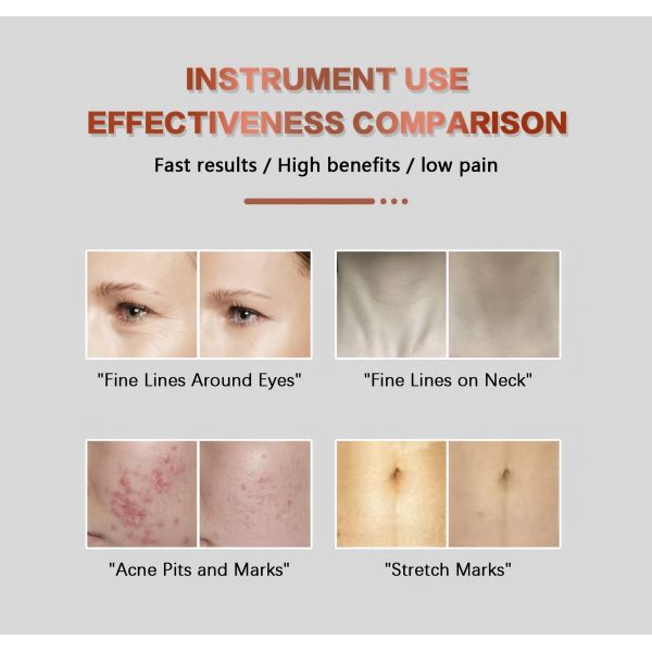 Non Surgical Radiofrequency Microneedling Device HIFU Skin Rejuvenation Device