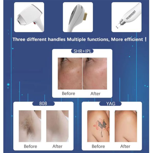 3 IN 1 Nd Yag 808nm Diode Laser Hair Tattoo Removal IPL Acne Treatment Machine