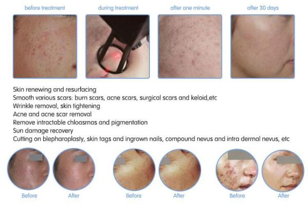 Multifunction medical laser co2 fractional/fractional co2 laser/co2 fractional laser CE/FDA approval