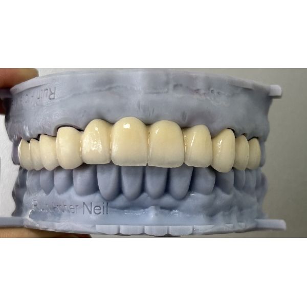 Semi-precious Porcelain Fused to Metal Dental Bridge for Durable Dental Restoration