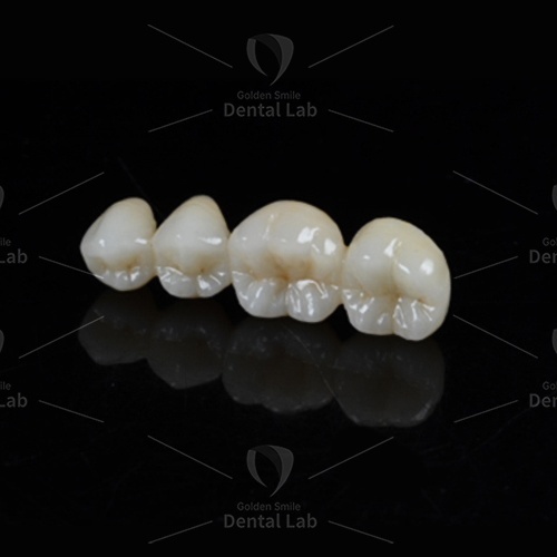 Cut Back Layered Zirconia Hybrid Monolithic Veneer 3D Multilayer Zirconia