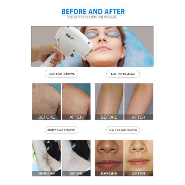 Безболезненная Pro портативная машинка лазера диода машины 1064nm 808 удаления волос лазера диода