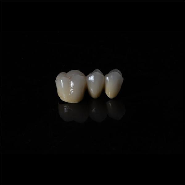 Anti Wear Implant PFM Dental Bridge Prosthesis Teeth Replacement