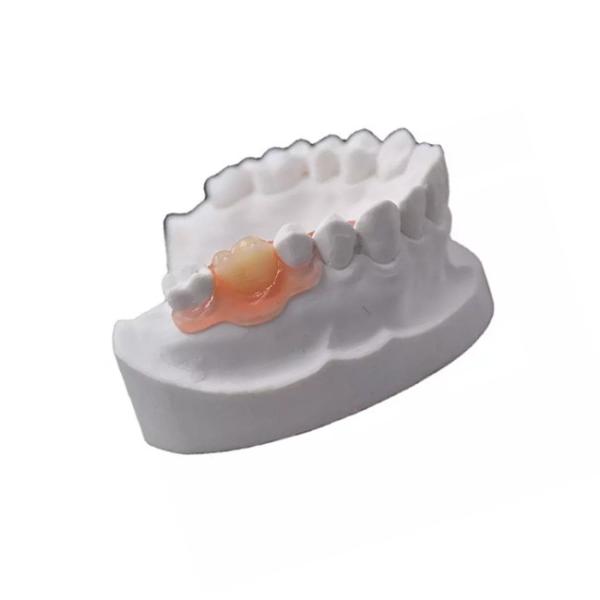 Comfortable Beautiful PFM Temporary Dental Crown Wholesale High Chewing Efficiency