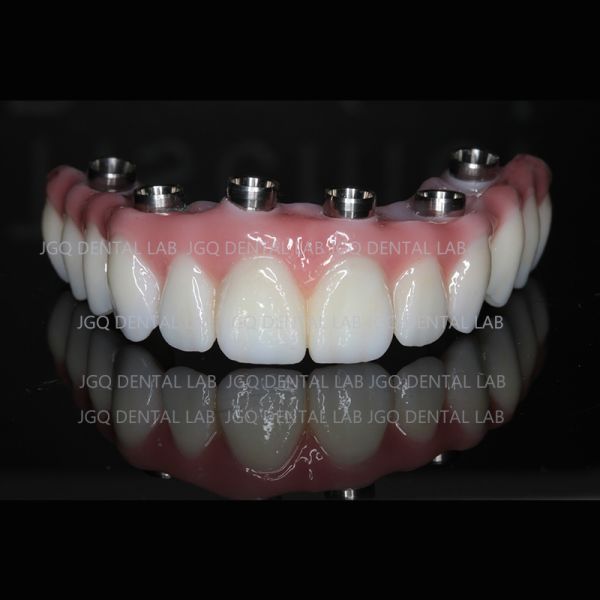 Titanium Abutments Dental Implant Screw Retained Crown For Dental Restoration