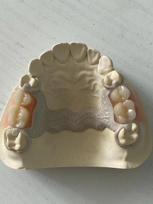 Customized Dental PEEK Acrylic Partial Denture Adjustable With Secure Fit