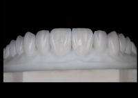 Translucidez Natural Estética Coroas de Zirconia Excelente Biocompatibilidade E Força