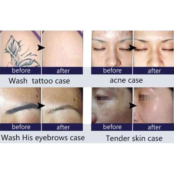 Eliminación de vello con láser de diodo Rejuvenecimiento de la piel Máquina de belleza Pico láser 2 en 1