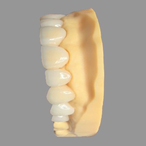 Smooth Pressed IPS EMax Crowns Staining Resistant Customizable