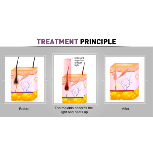 600W 220V 810nm Diode Laser Anti Wrinkle Machine