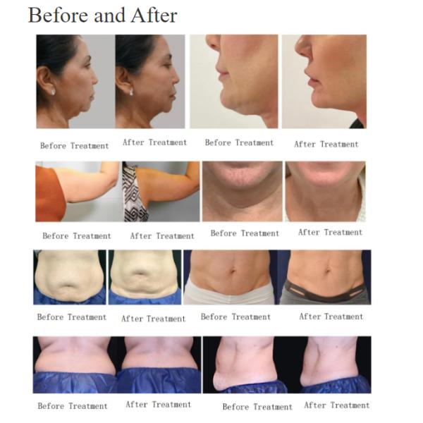 10.4-inch Touch Screen Jisu Id + Body Sculpting Ems RF Two In One Non-Surgical Body Shaping Therapy Machine