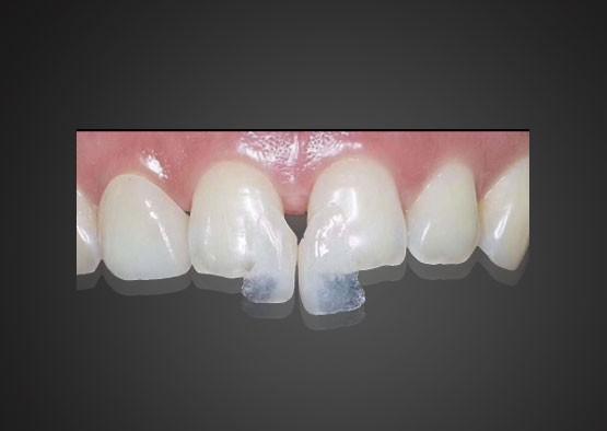 IPS 0.2mm Ultra Thin Emax Veneers Stain Resistant With High Strength